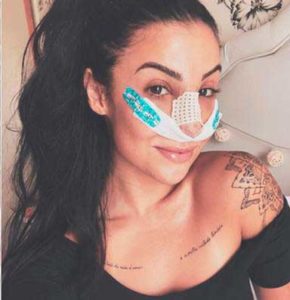 Bianca Andrade com curativos da cirurgia plastica de nariz