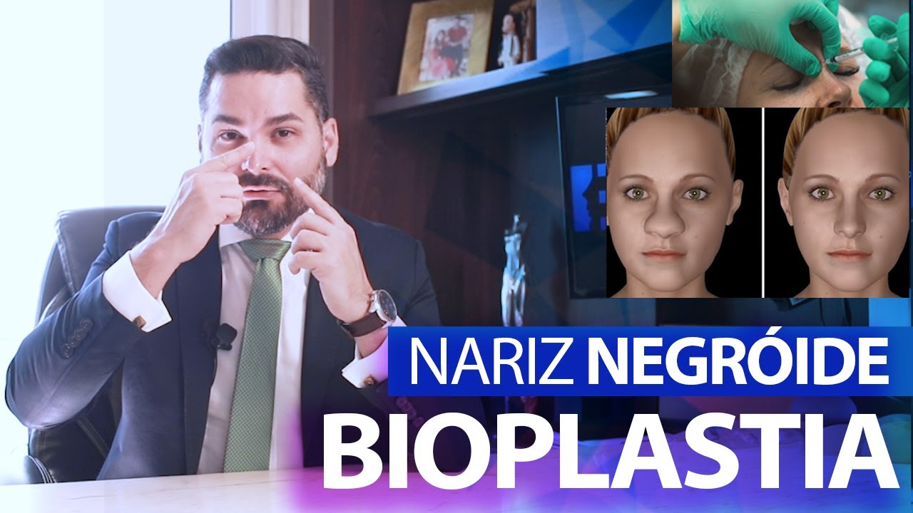 Bioplastia para Nariz Negroide | Bioplastia funciona em Nariz Bulboso?