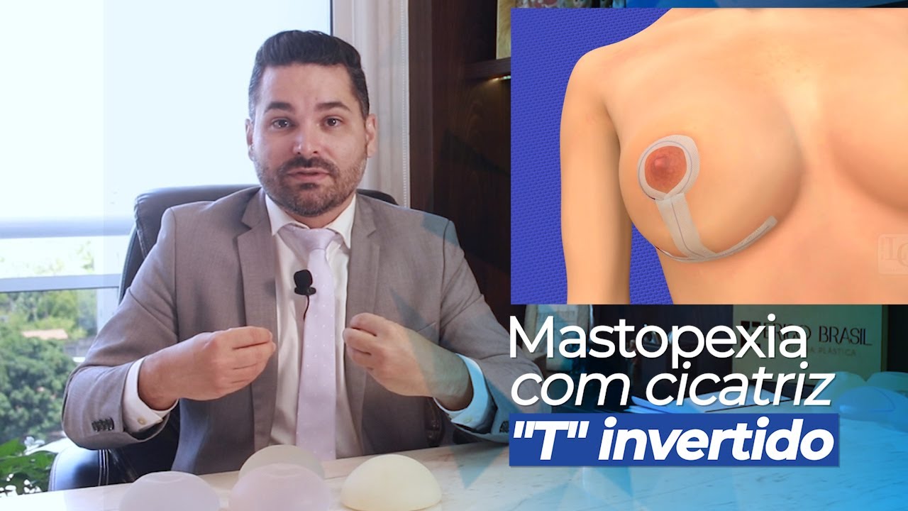 Mastopexia em L – Cicatriz em L na cirurgia de levantamento de seios