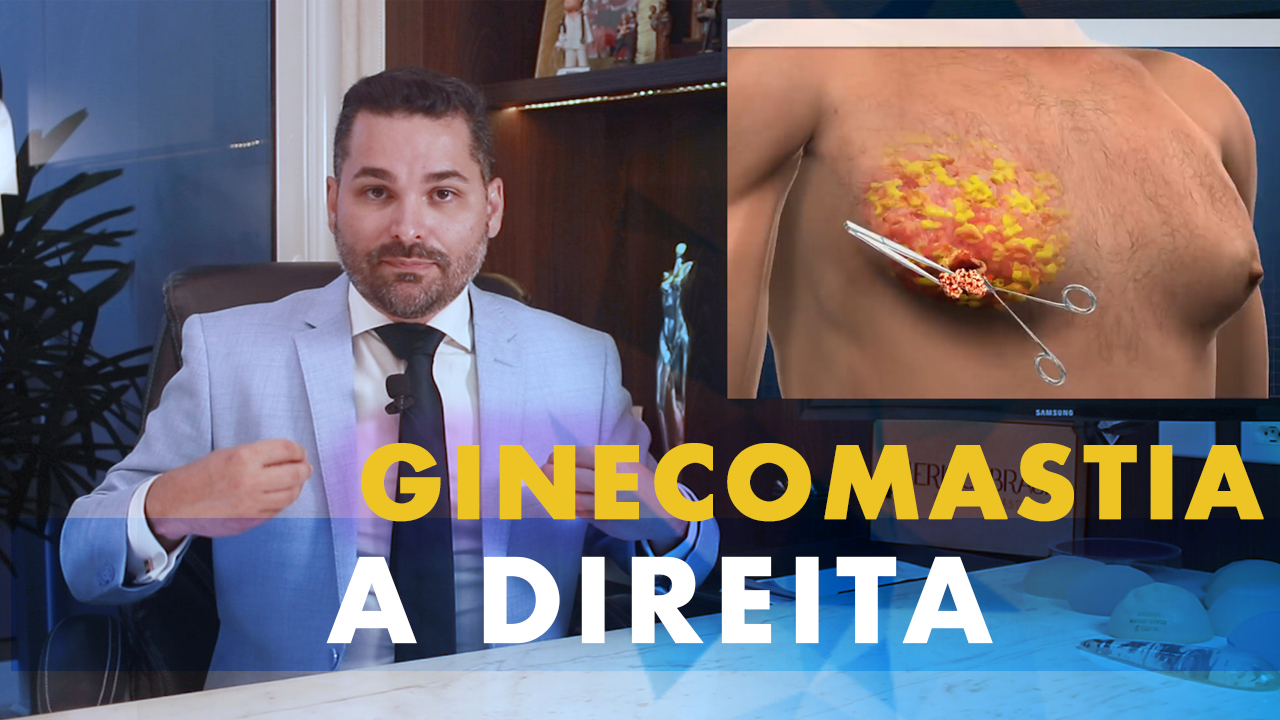 Ginecomastia a Direita