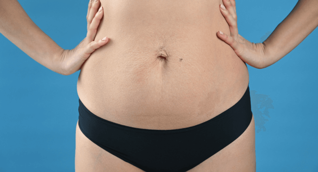 Dr Erico Brasil Abdominoplastia robotica em Fortaleza